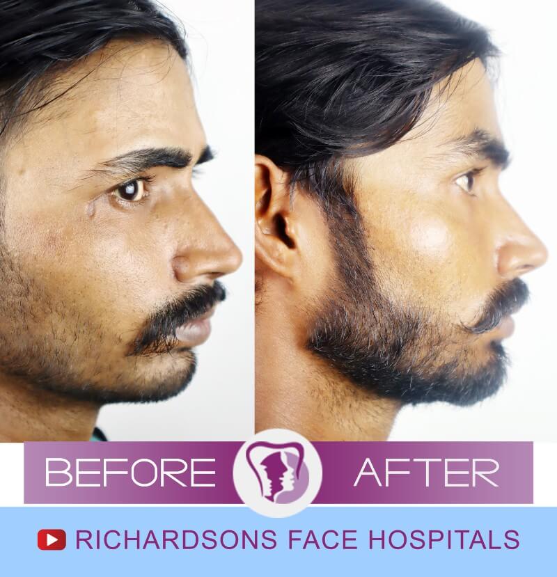 Scar Removal Surgery Richardson S Plastic Surgery Hospitals