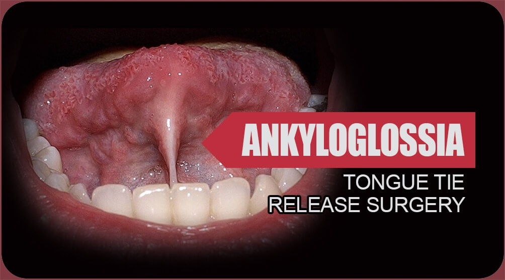 Ankyloglossia surgery in India