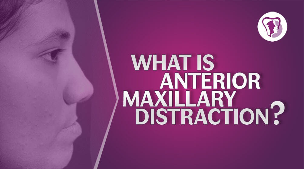 Anterior Maxillary Distraction or AMD