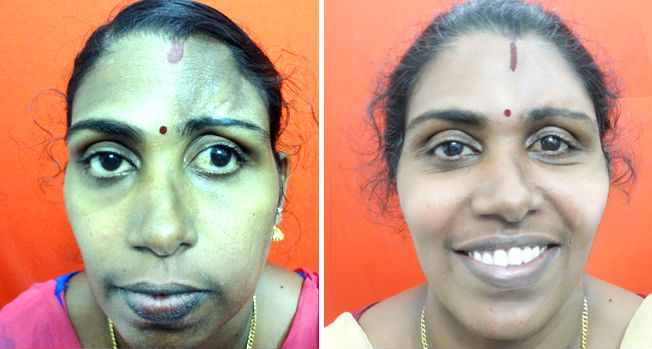 Asymmetric facial surgery in India