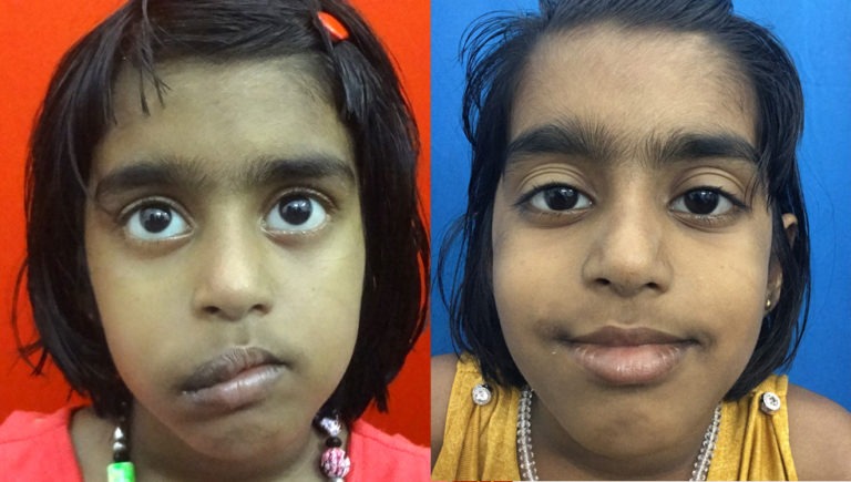 before and after hemangioma