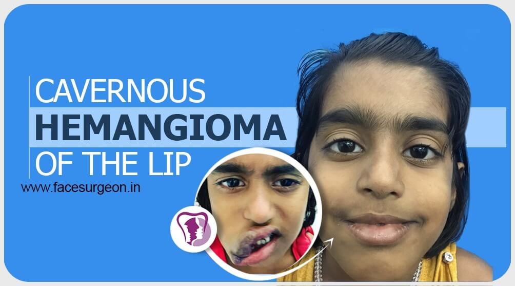 Cavernous Hemangioma of the lip