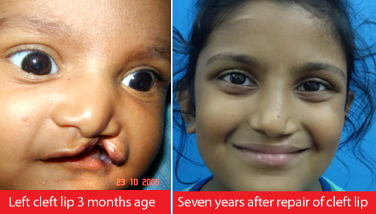 Cheiloplasty Surgery in India
