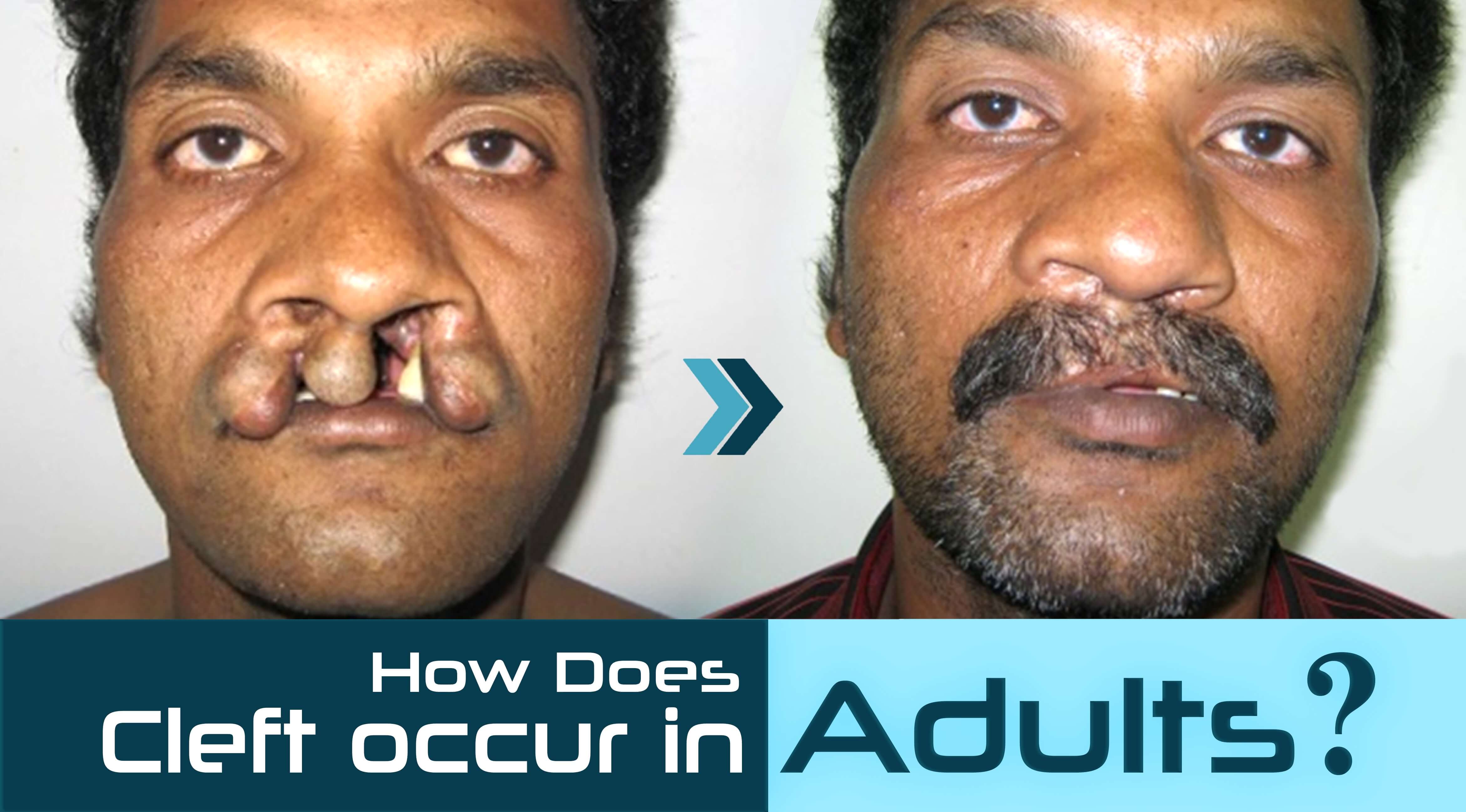 Cleft occur in adults