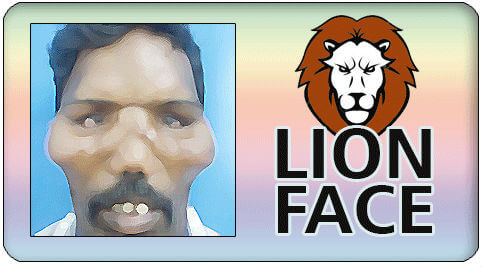 Facial esthetic surgery in India