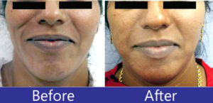 Fat augmentation on the face before after