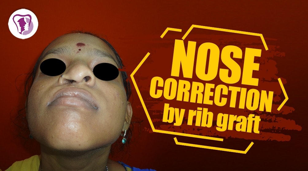 Nose correction