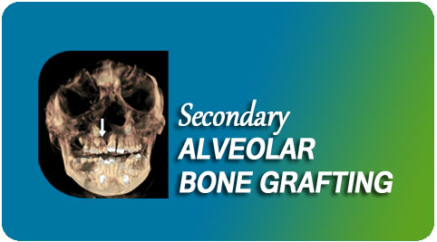 Secondary alveolar bone grafting Surgery India