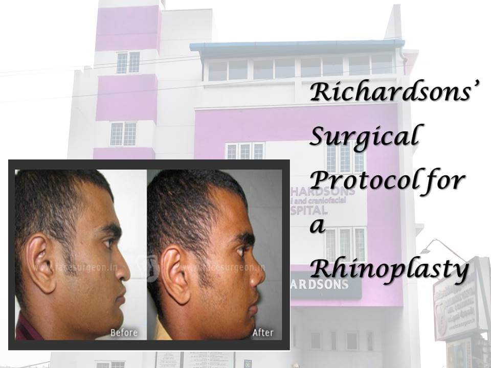 Surgical Protocol for a Rhinoplasty