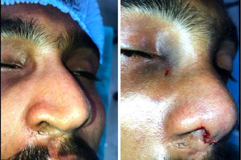 asymmetric nose correction surgeon in India