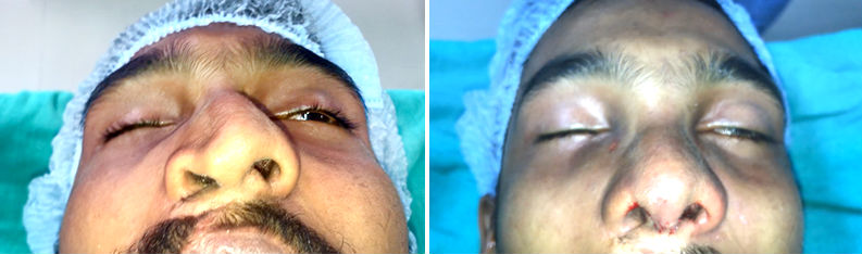 asymmetric nose correction surgery in India