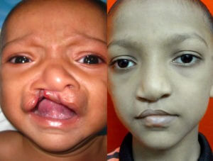 After and Before cleft palate Surgery in India