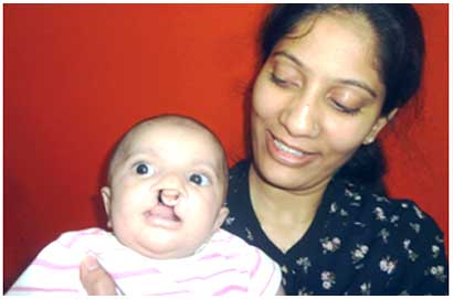 cleft lip surgery india