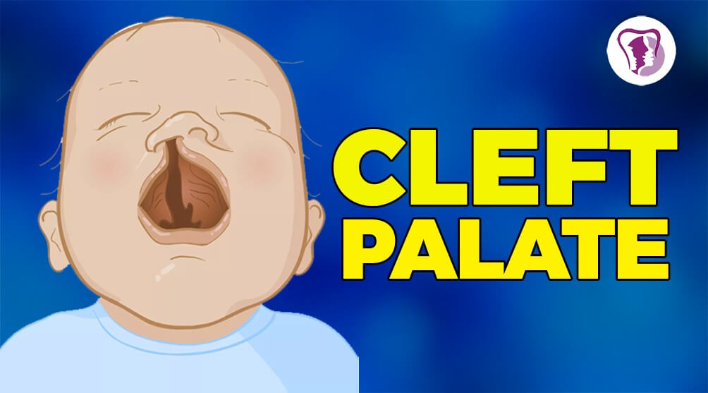 cleft palate baby