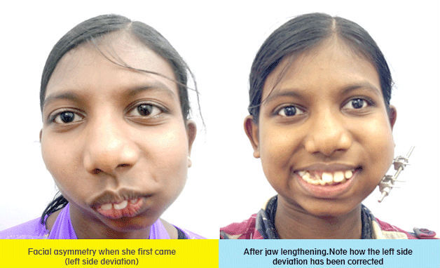 facial asymmetry correction surgery in India