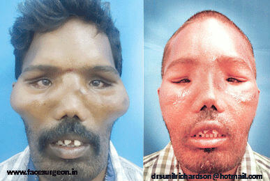 fibrous dysplasia treatment in India