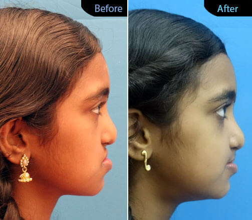 sunken midface correction Surgery in India