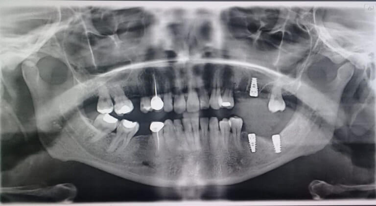 After Dental Implants
