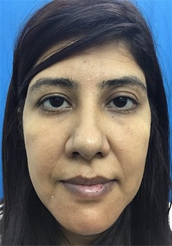 After Genioplasty Treatment in India