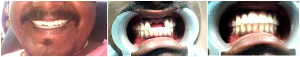 Missing tooth surgery in nagercoil