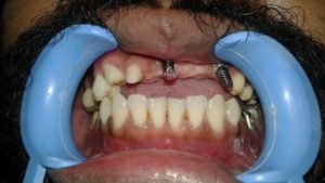 Before Dental Implants Treatment in Nagercoil