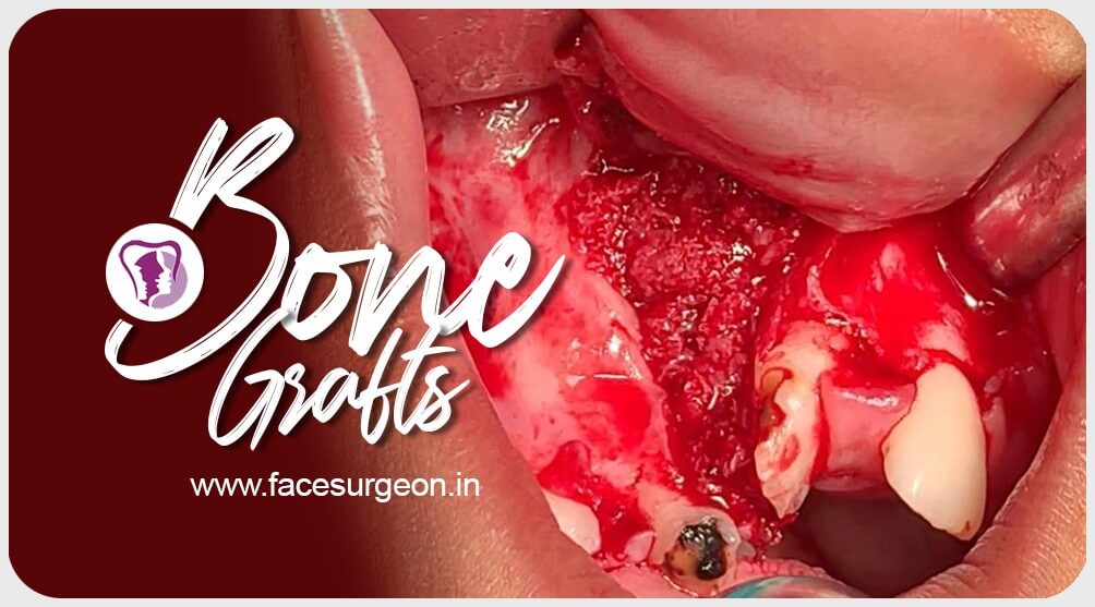 Bone Grafts Treatment in India