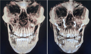 CBCT image of Orthognathic surgery