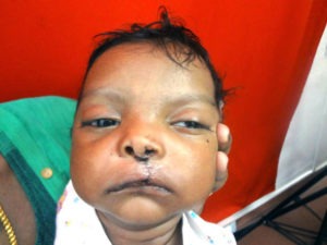 Cheiloplasty Cleft lip repair surgery in India