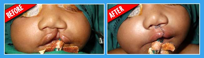 Cleft Lip Repair - procedure, recovery, blood, tube, time, operation,  pregnancy, cells