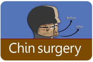 Chin Surgery in India