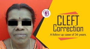 Cleft Correction Surgery in Tamil Nadu