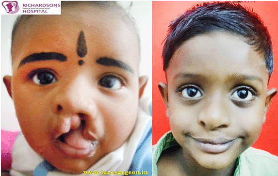 Cleft Lip and Palate Repair