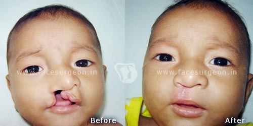 Cleft Nasal Rhinoplasty in Nagercoil