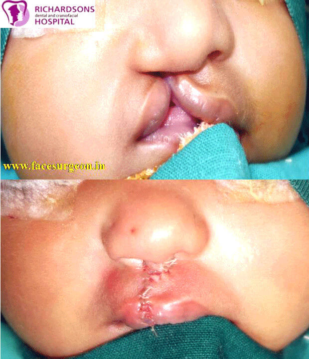 Cleft lip repair surgery in India