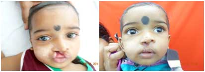 Cleft lip surgery for baby
