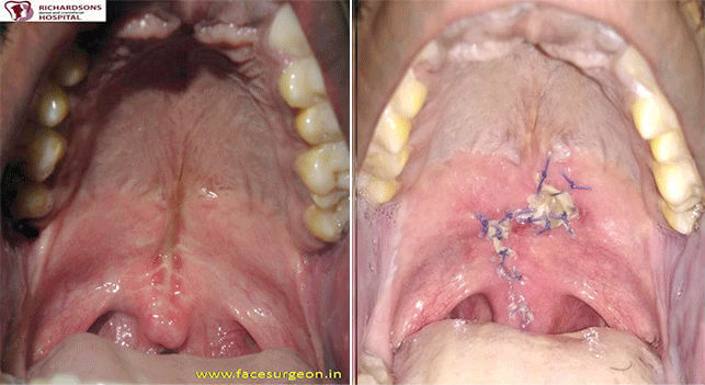 Cleft palate repair Surgery in India