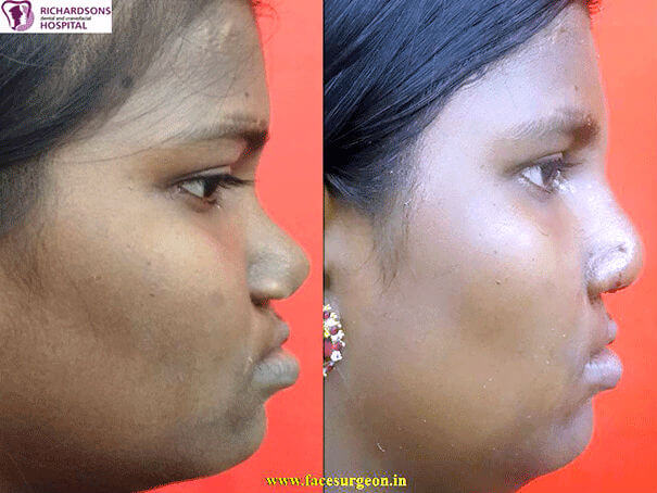 Cleft rhinoplasty in India