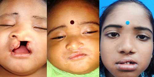 Cleft rhinoplasty surgeries in India