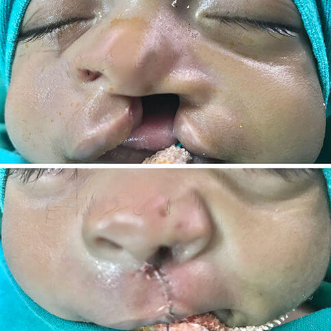 Complete wide left cleft lip alveolus and palate