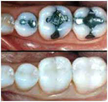 tooth coloured composite restoration
