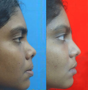 Corrective Nose Surgery in Nagercoil