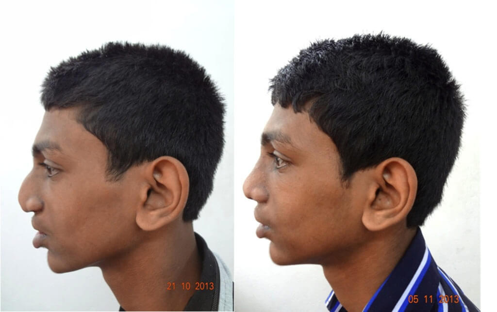Cosmetic Nasal Surgery Before and After