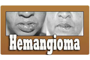 Craniofacial Hemangioma Treatment in India