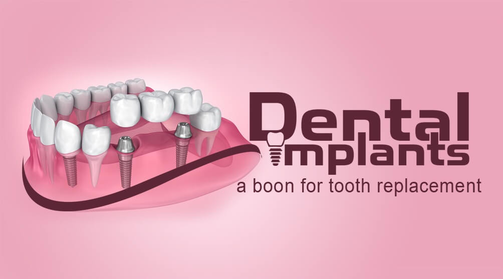Dental Implants Tooth Replacement