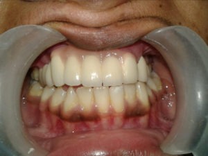 Dental Rehabilitation After Treatment in India