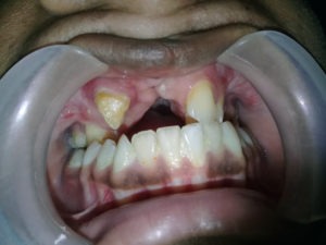 Dental Rehabilitation Before Treatment in India