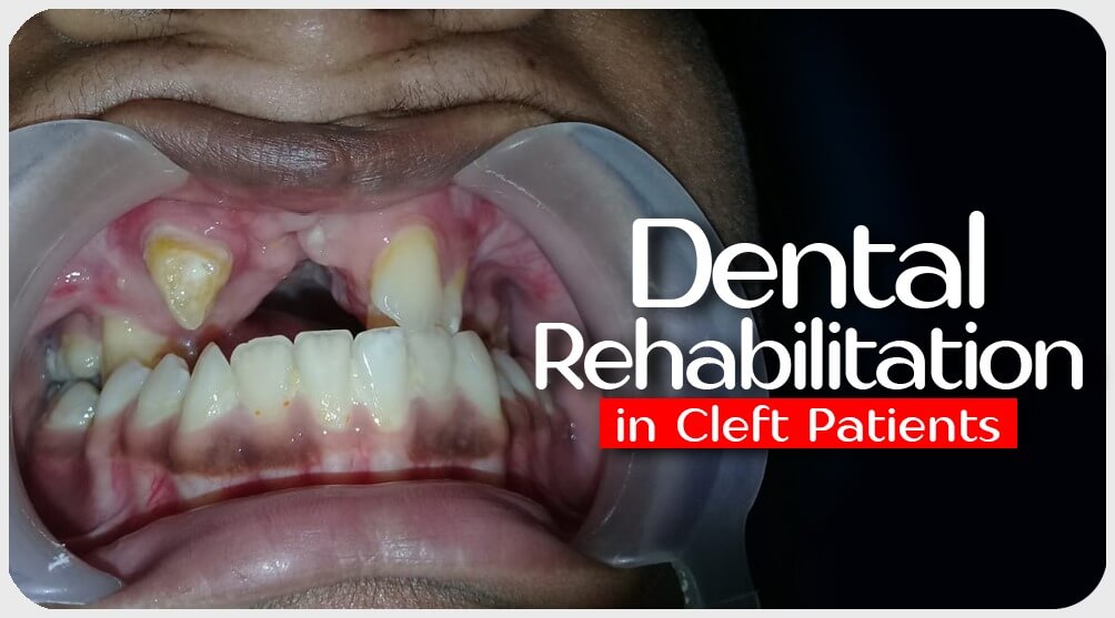 Dental Rehabilitation in India