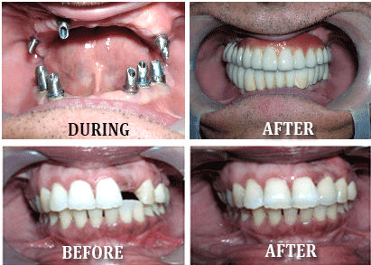 Dental implant Surgery in India