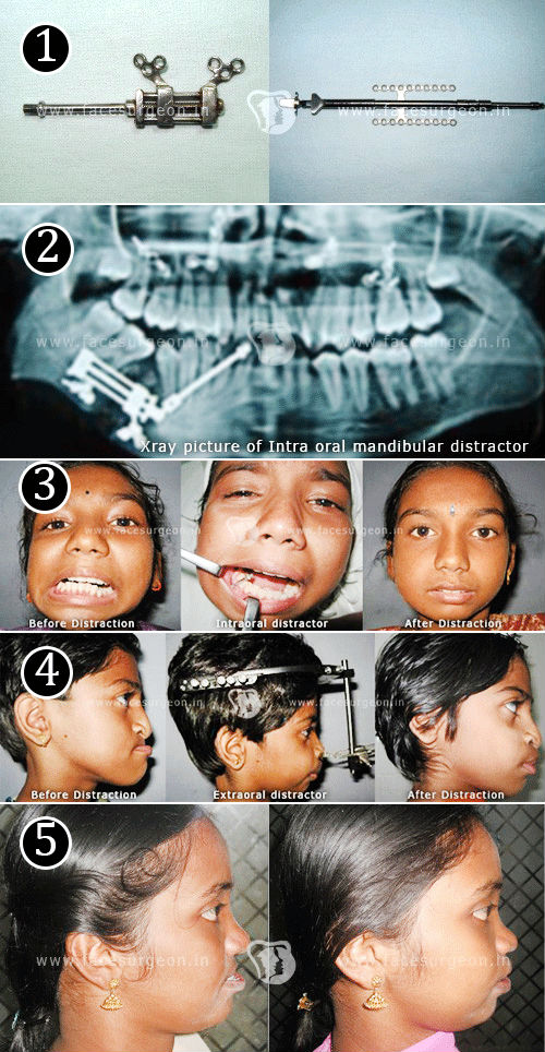 Distraction Oestogenisis surgery in India