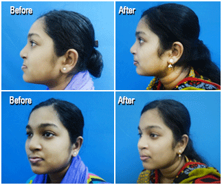 Distraction Osteogenesis Treatment in Nagercoil